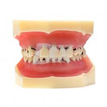 Модель демонстраційна з пародонтологічними патологіями і вісімкою HST-L4