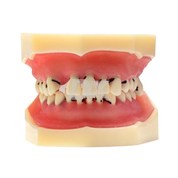 Модель демонстраційна з пародонтологічними патологіями і вісімкою HST-L4 - фото . Купити з доставкою в інтернет магазині Dlx.ua.