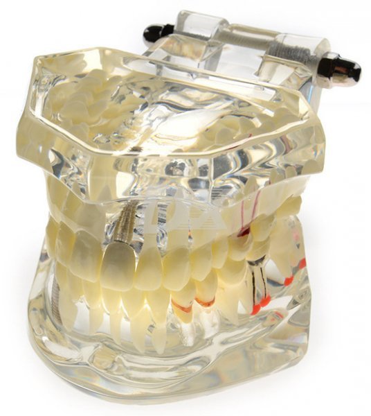 Модель навчальна хірургічна імплант 110-07 - фото . Купити з доставкою в інтернет магазині Dlx.ua.