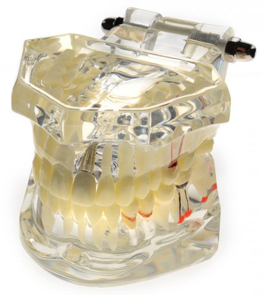 Модель навчальна хірургічна імплант 110-07 - фотография . Купить с доставкой в интернет магазине Dlx.ua.